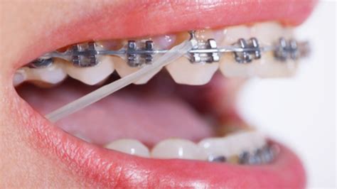 ligas de metal para brackets|ligas en brackets.